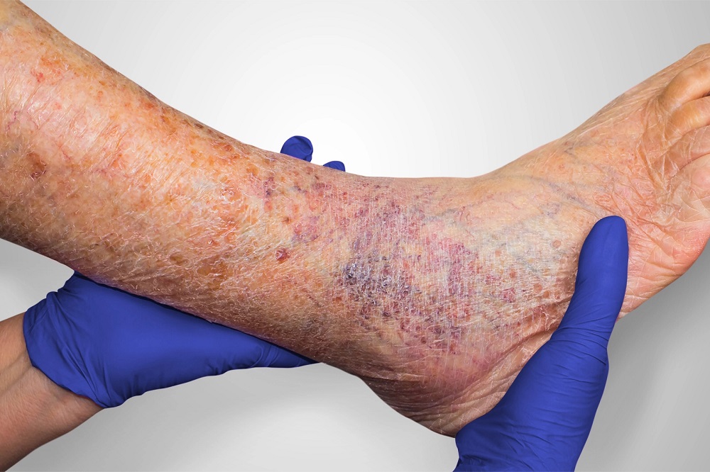 Warning Signs of Vein Disease, Discoloration of the Skin