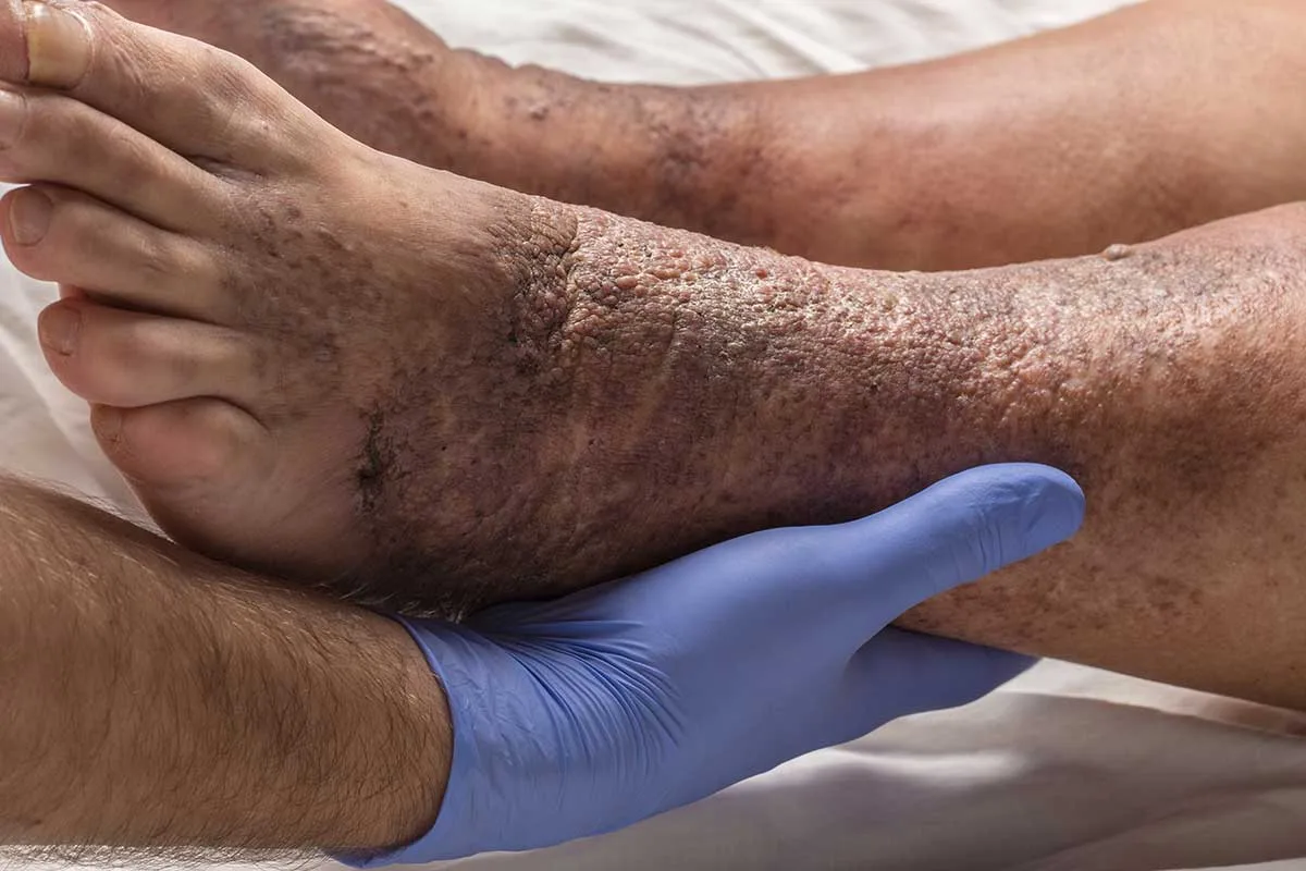complications of untreated varicose veins #2 cellulitis 1