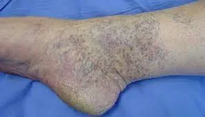 untreated varicose veins
