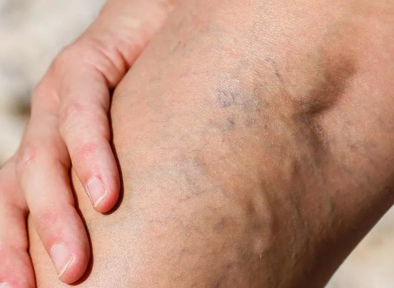 varicose vains improve skin condition