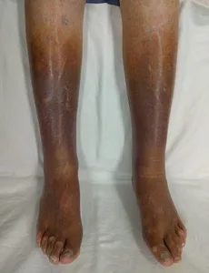 image of Chronic insufficiency