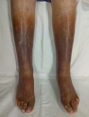 image of Chronic insufficiency