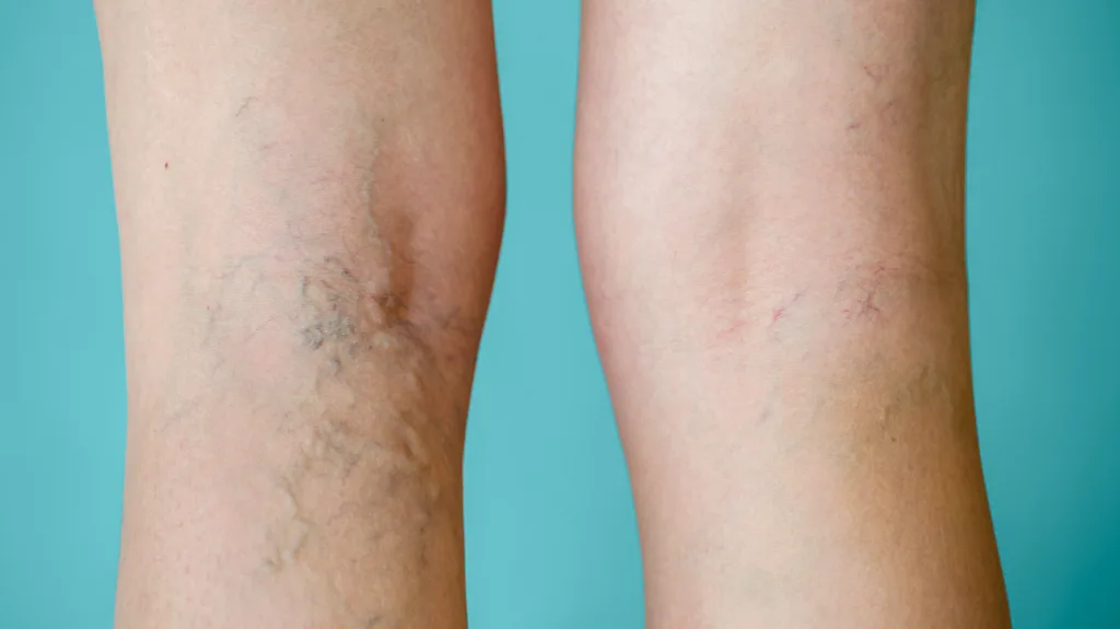 varicose veins