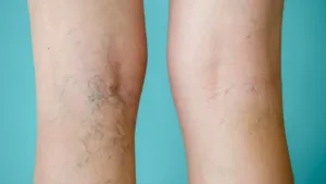 varicose veins