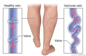 valves within the leg veins