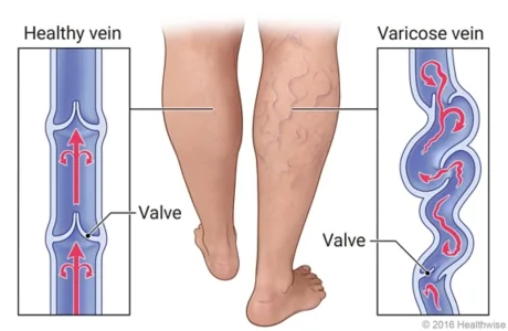 valves within the leg veins