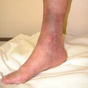 veins ulcers