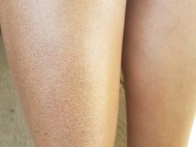 close up of a woman's dry flaky itchy legs