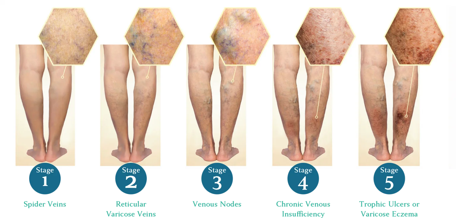 chronic venous insufficiency stages of development of varicose