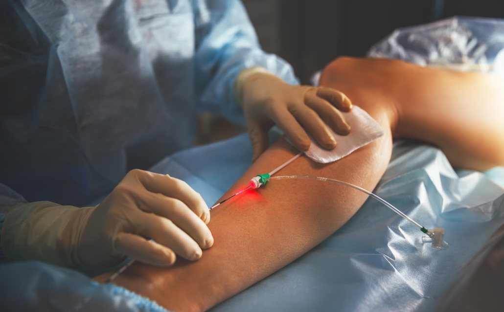 Endovenous laser vein ablation therapy (EVLT) uses a tiny catheter to seal incompetent veins shut.