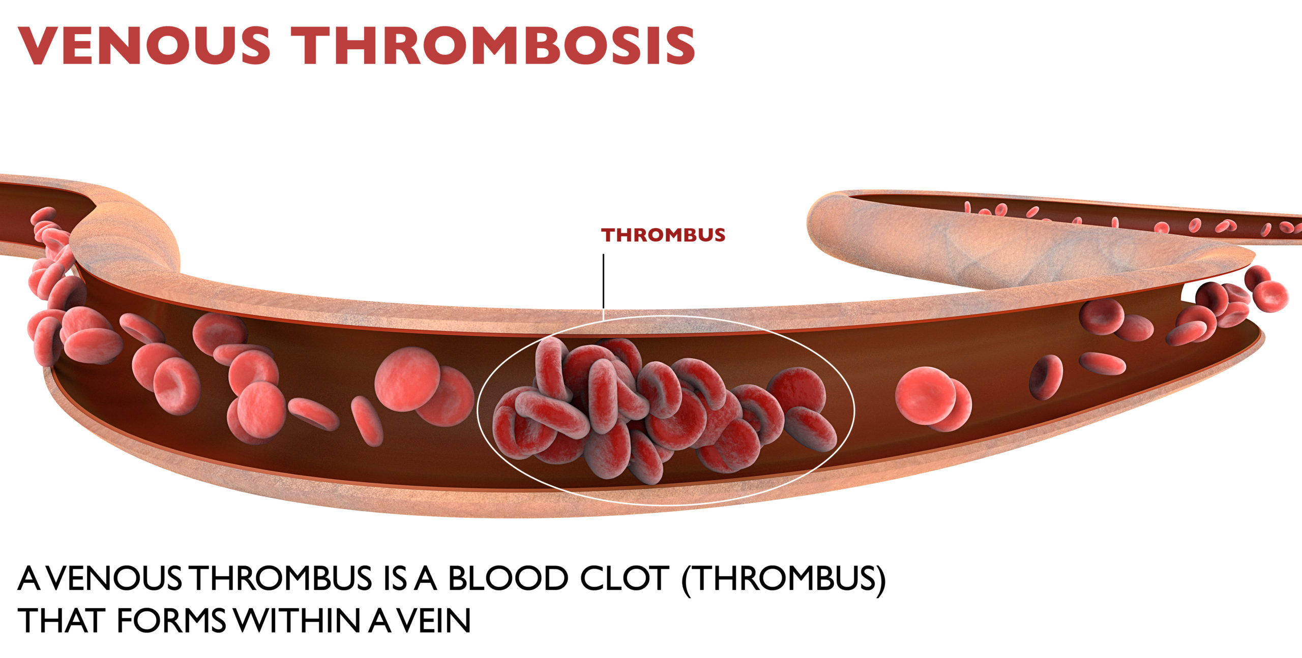 Johnson and Johnson Vaccine and Deep Venous Thrombosis (DVT) blood clots