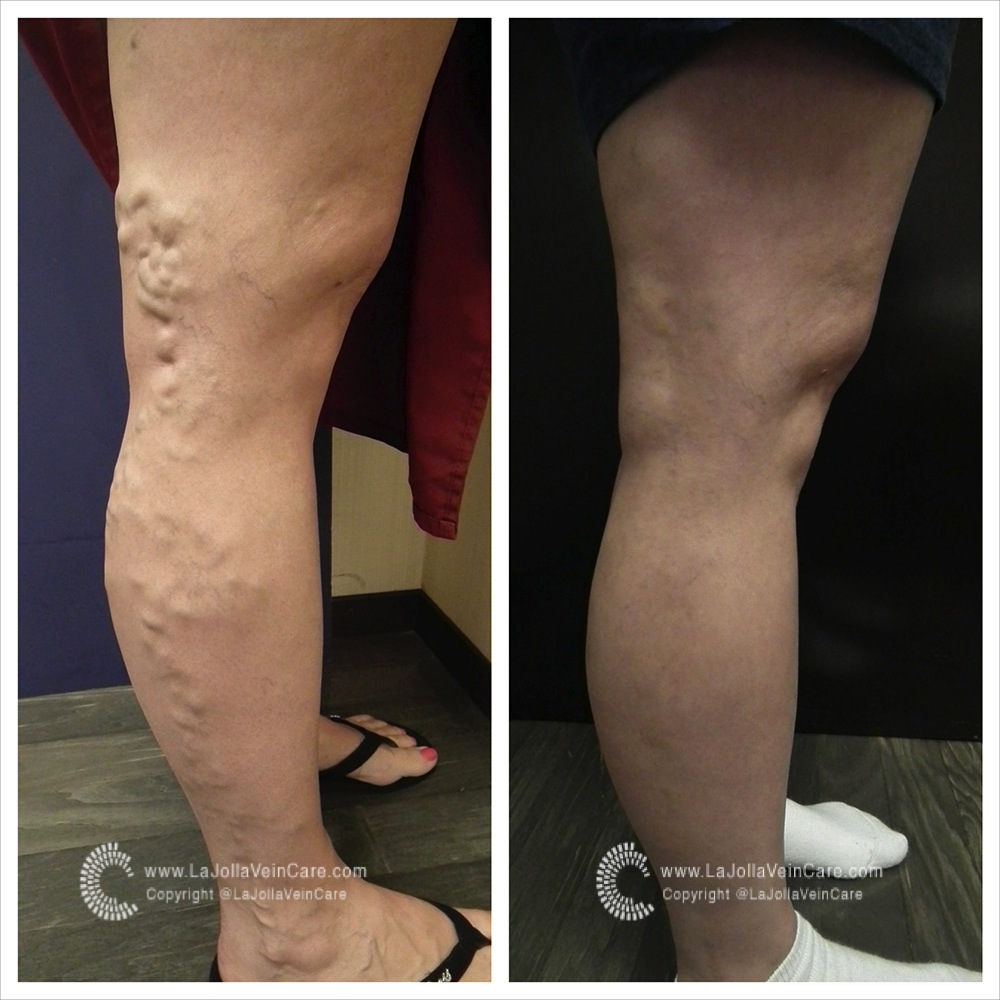 varicose vein before after