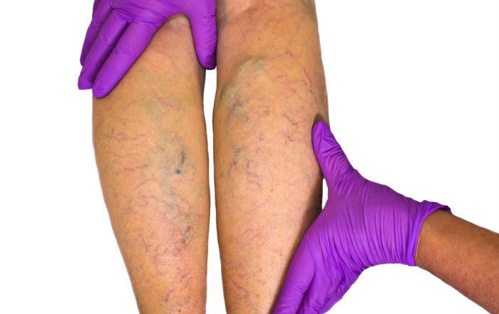 Medi-Cal Coverage for Varicose Veins and Leg Ulcers in San Diego at La Jolla Vein Care