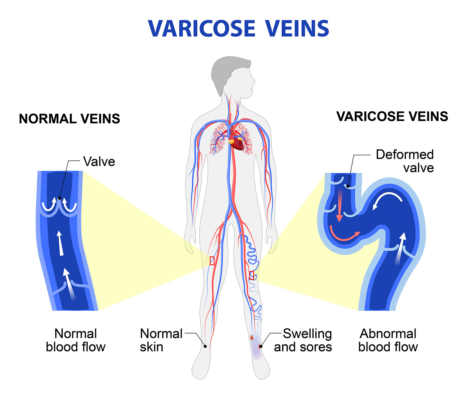 varicose veins infographic