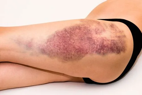 how to reduce bruising after vein surgery?