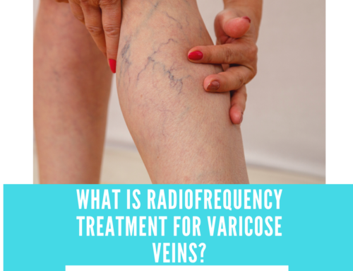 What is Radiofrequency Treatment for Varicose Veins?