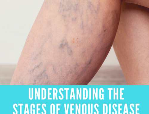 Understanding The Stages of Venous Disease
