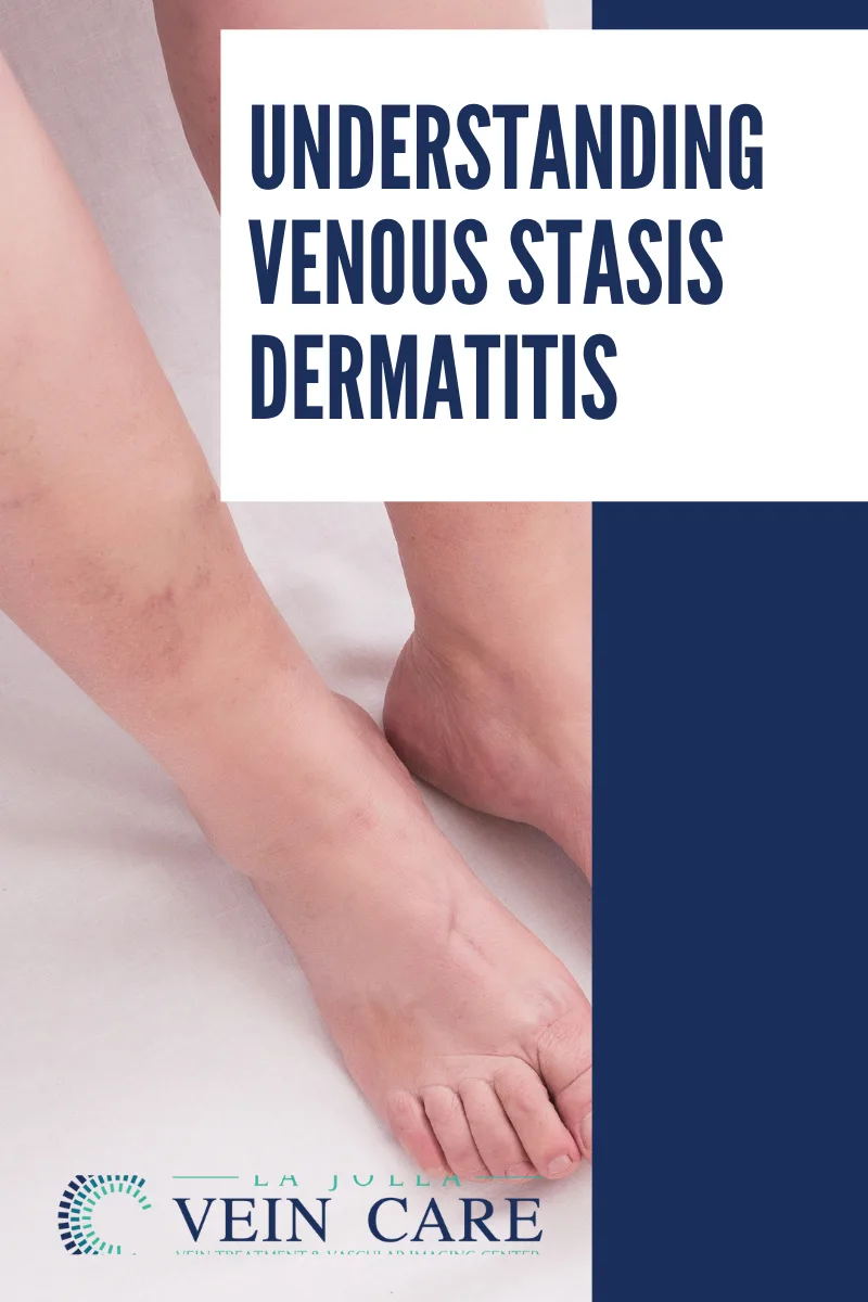 understanding venous stasis