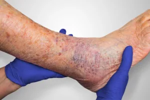 Stasis dermatitis 