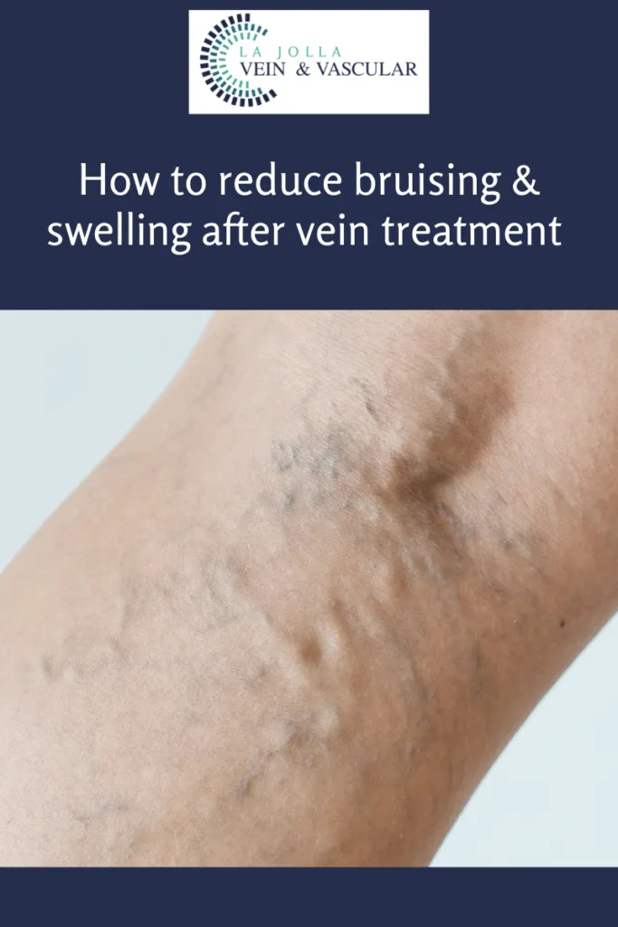 leg with varicose veins 