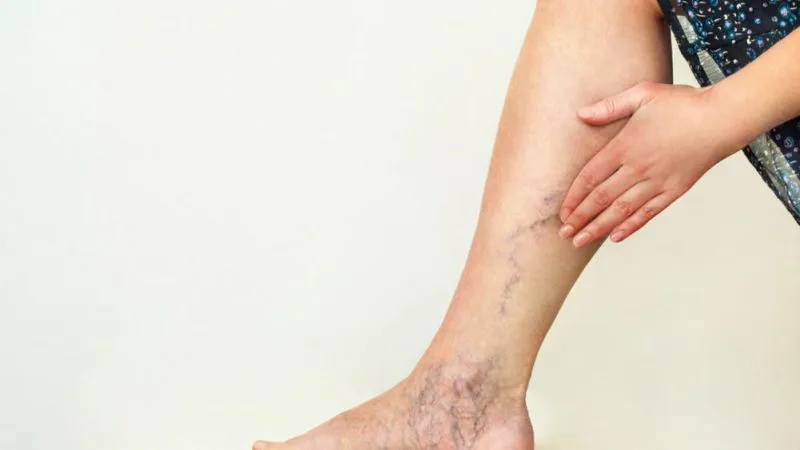 complications of varicose veins 6 darkening of the skin 800x450
