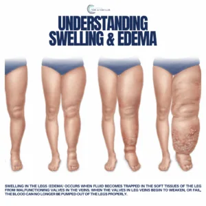 swelling