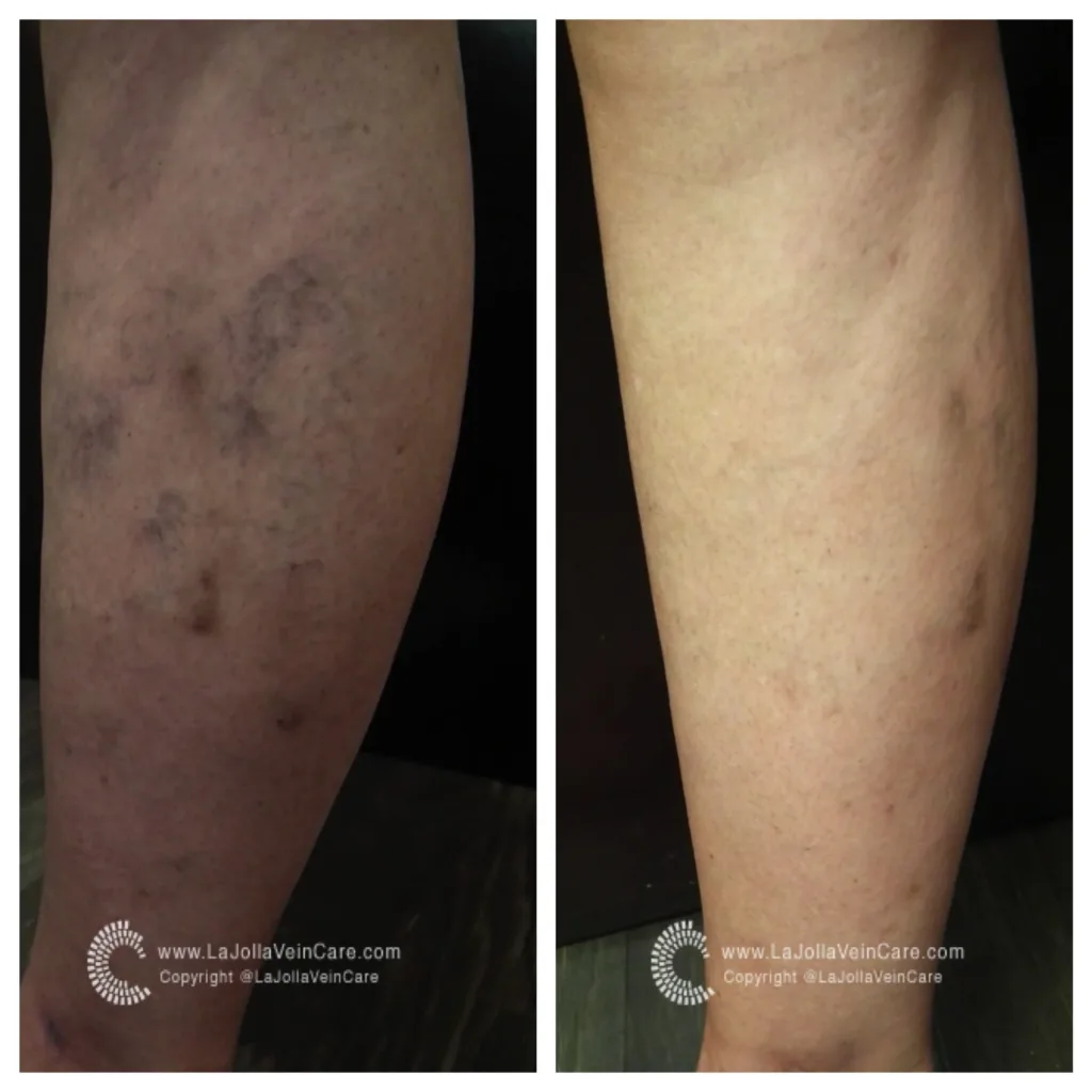 SPIDER VEINS BEFORE AND AFTER