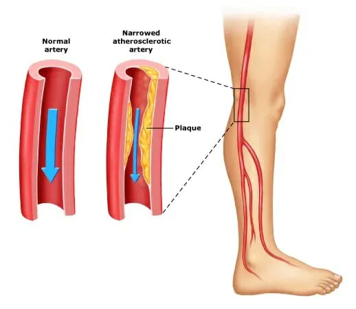 peripheral arterial disease (PAD) illustration showing effects of plaque build up in a leg artery