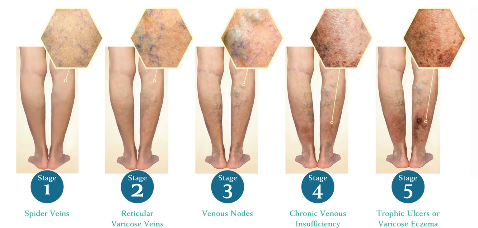Diagram of the 5 stages of vein disease from spider veins, to varicose veins to venous nodes to chronic venous insufficiency to leg ulcers in stage 5