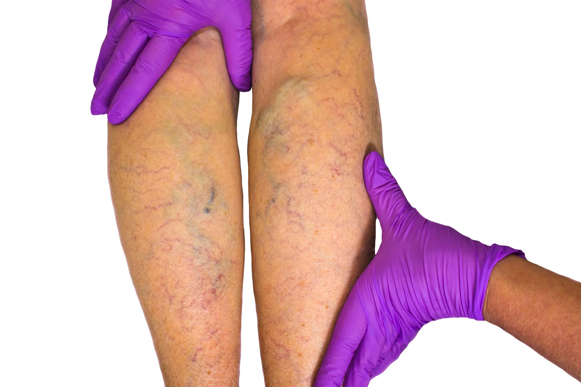 example of vein disease in legs