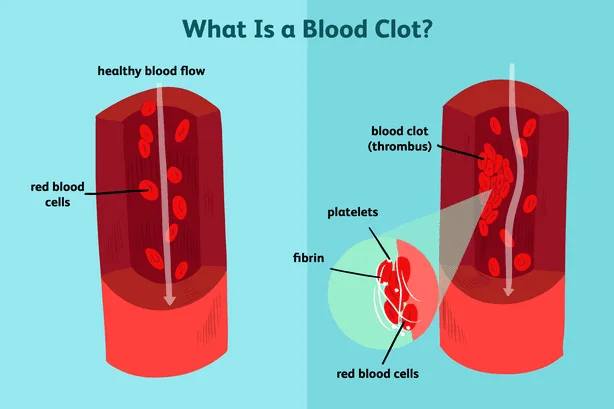 illustration showing effects of blood clots
