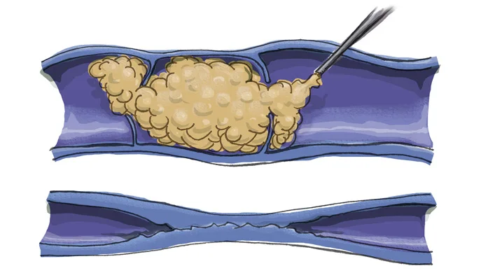cross section of Illustration of a vein with foam sclerotherapy injection