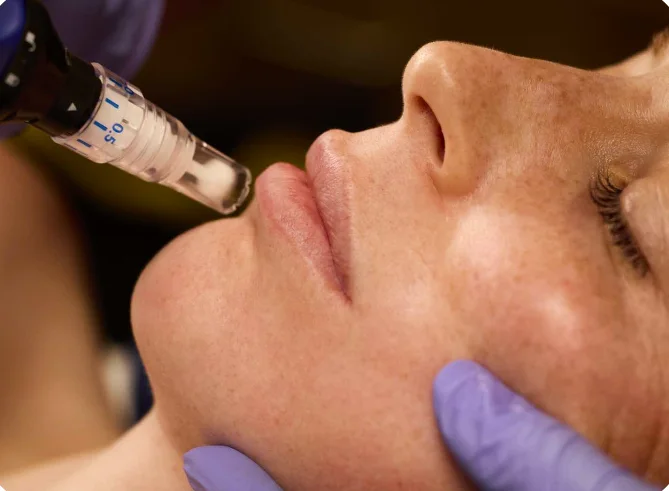 microneedling2