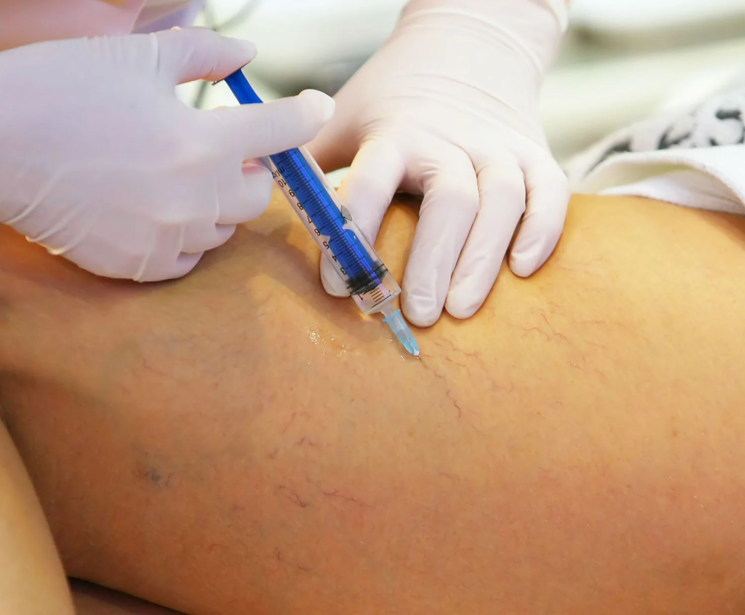 Sclerotheraphy injection into leg to remove spider vein