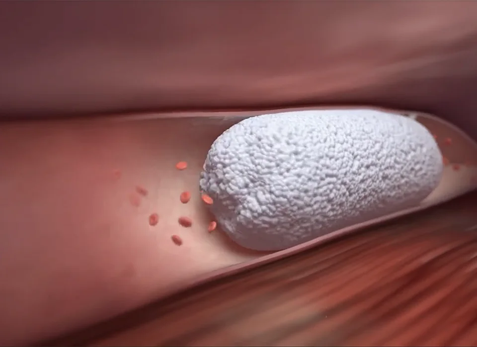 illustration of varithena foam injection
