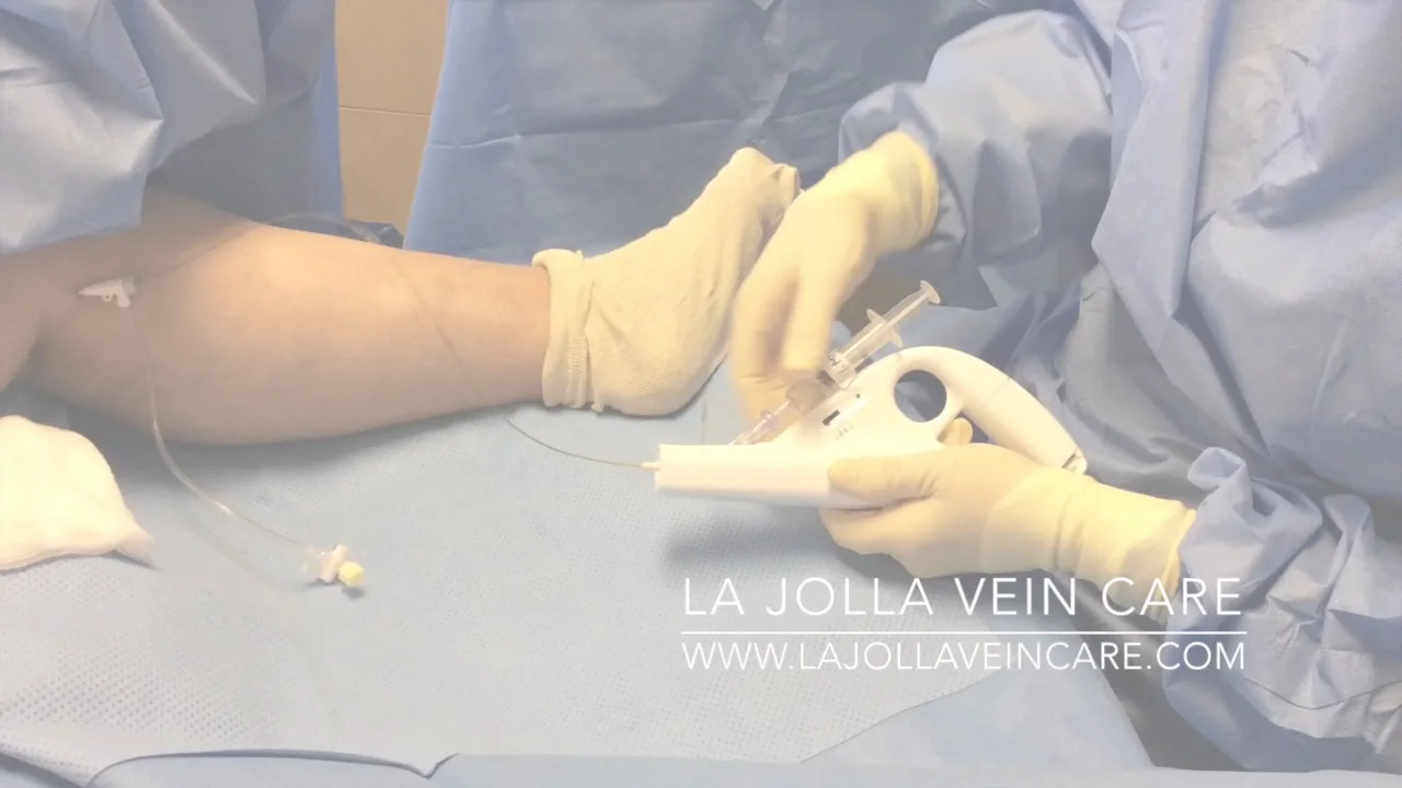 clarivein procedure
