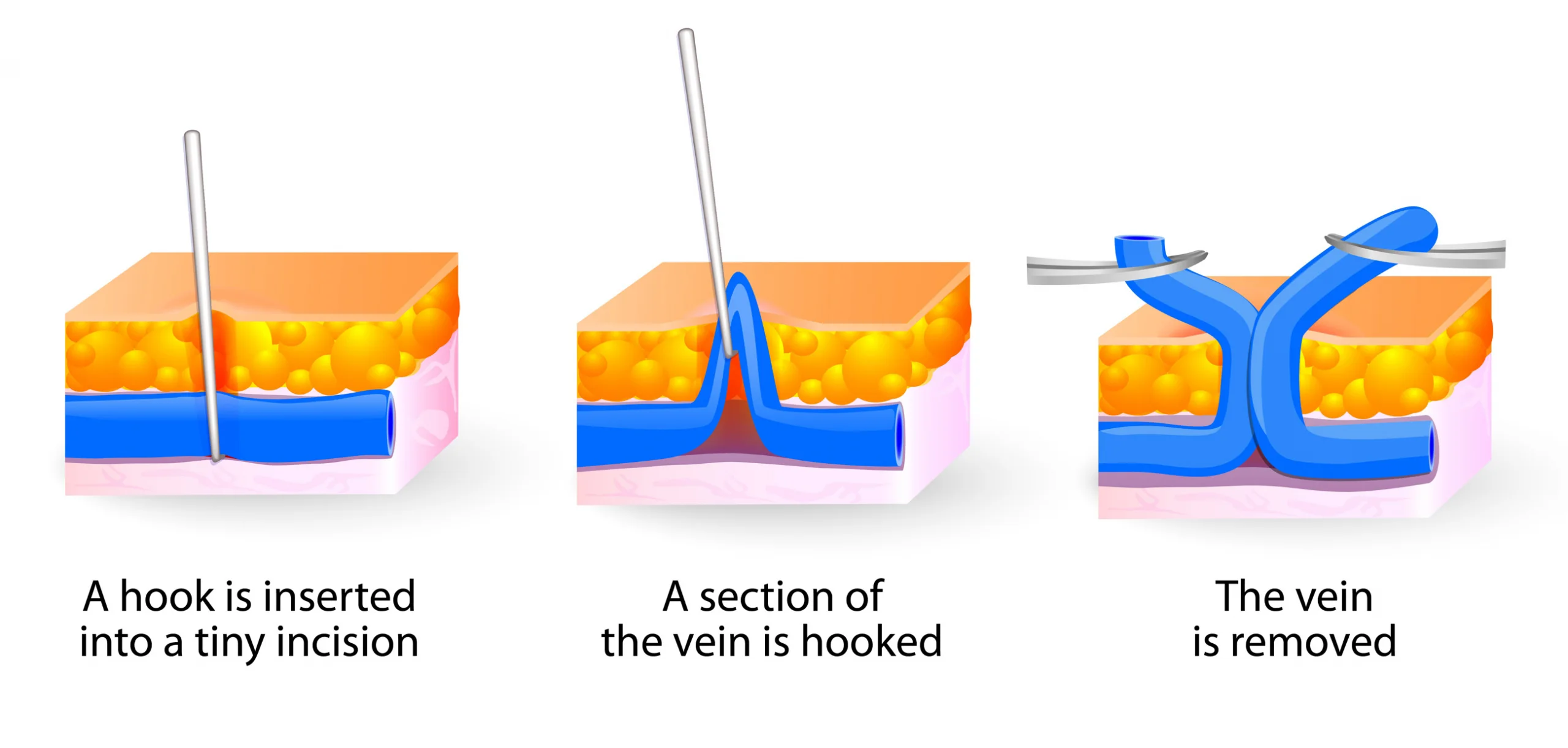 diagram of phlebectomy