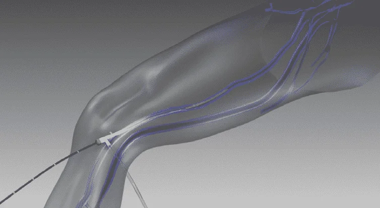 rfa diagram of radio frequency ablation of leg vein