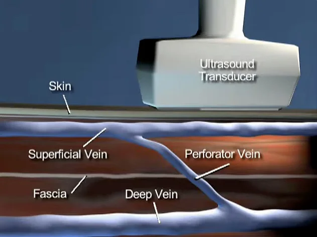 rfa perforator illustration