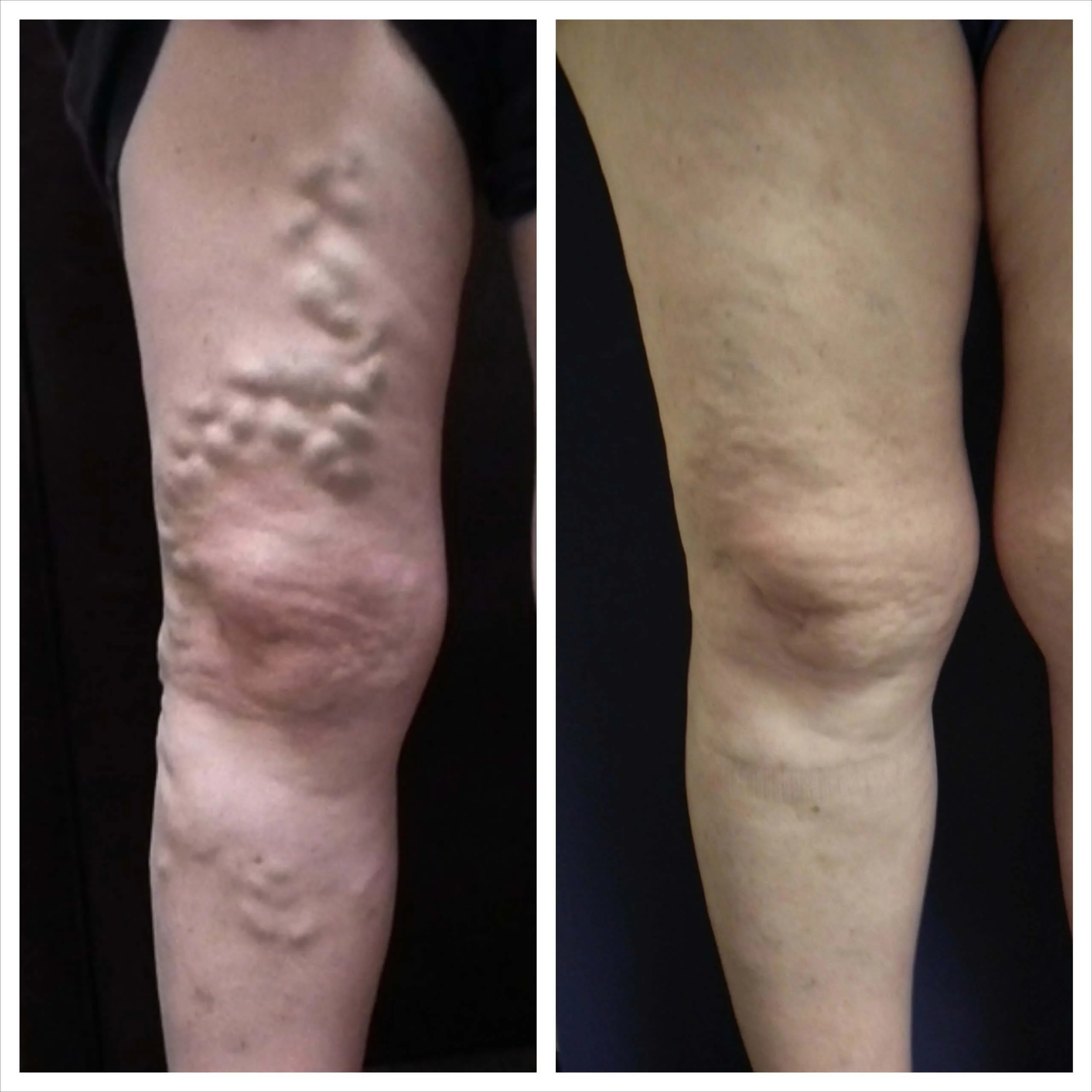 Before and After Vein Treatment