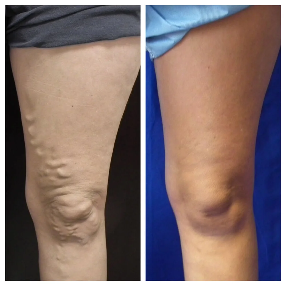 Before and After Vein Surgery