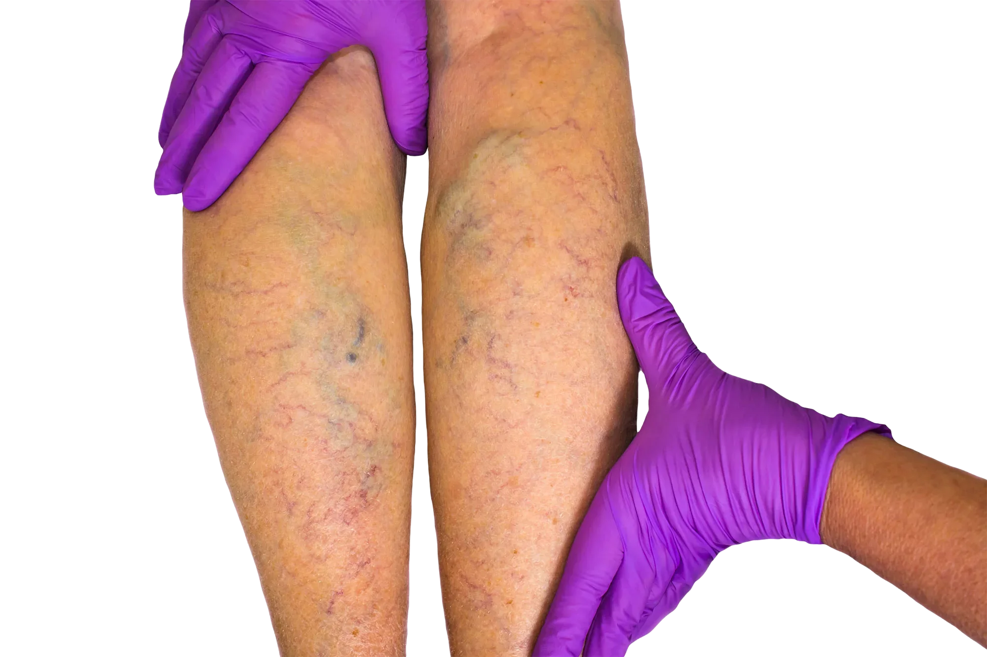 do i have vein disease banner